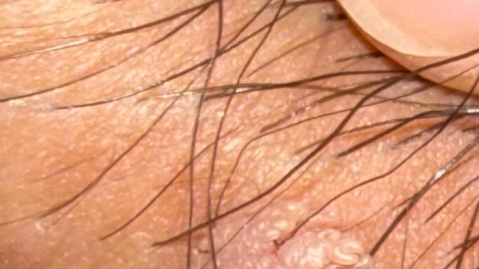 HPV có phải là sùi mào gà không? Cách phân biệt đúng để tránh hiểu nhầm