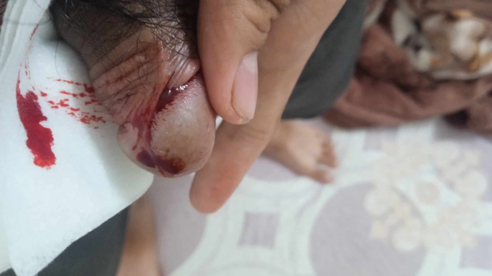 Đứt dây hãm bao quy đầu không khâu được không? Khi nào cần khâu hoặc tạo hình?